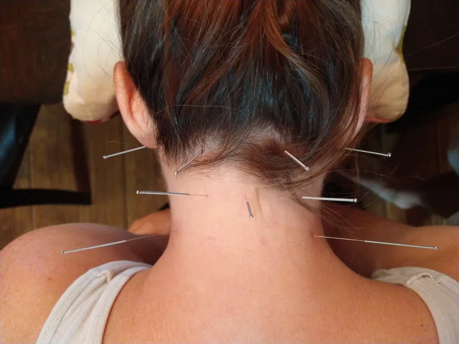 Close-up of trigger point dry needling treatment in progress on a patient's neck and upper back