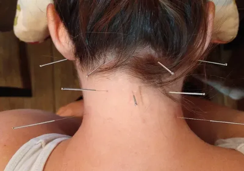 Clinician performing dry needling trigger-point treatment
